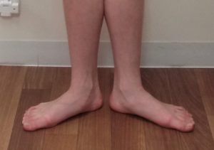 偏平足と有痛性外脛骨 2 偏平足と有痛性外脛骨の関係